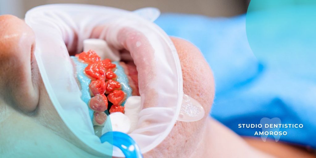 Sbiancamento dentale: avere denti più bianchi è possibile! Donna che effettua uno sbiancamento dentale per risolvere le discromie estetiche