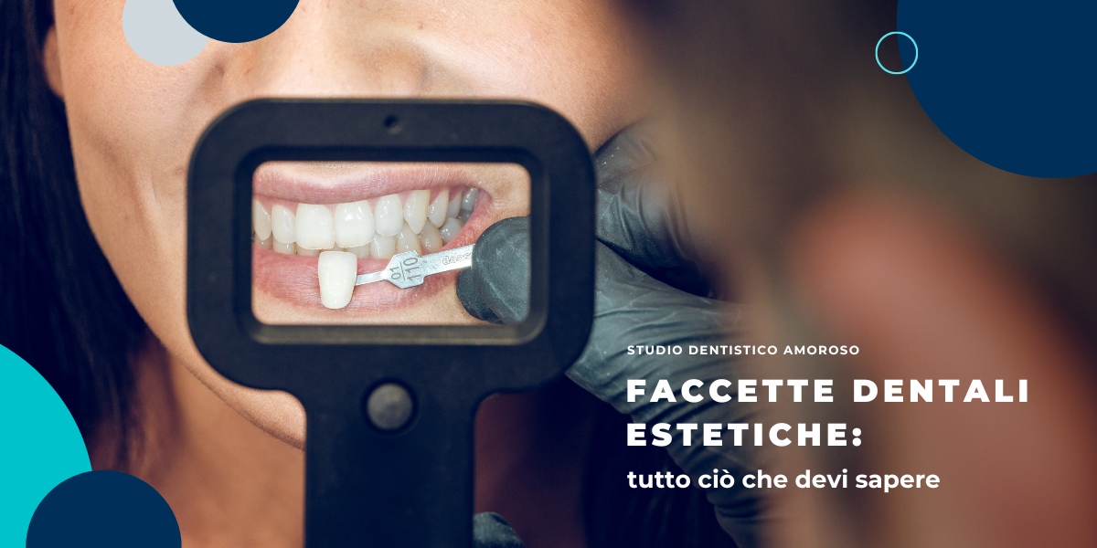 Faccette dentali estetiche: tutto ciò che devi sapere