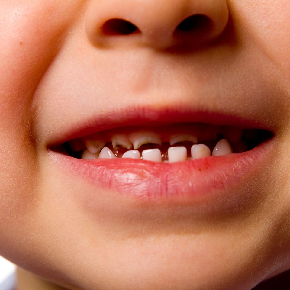 traumi4 Odontoiatria infantile