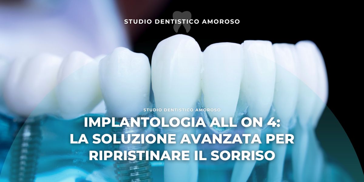 Implantologia All o 4: la soluzione avanzata per ripristinare il sorriso