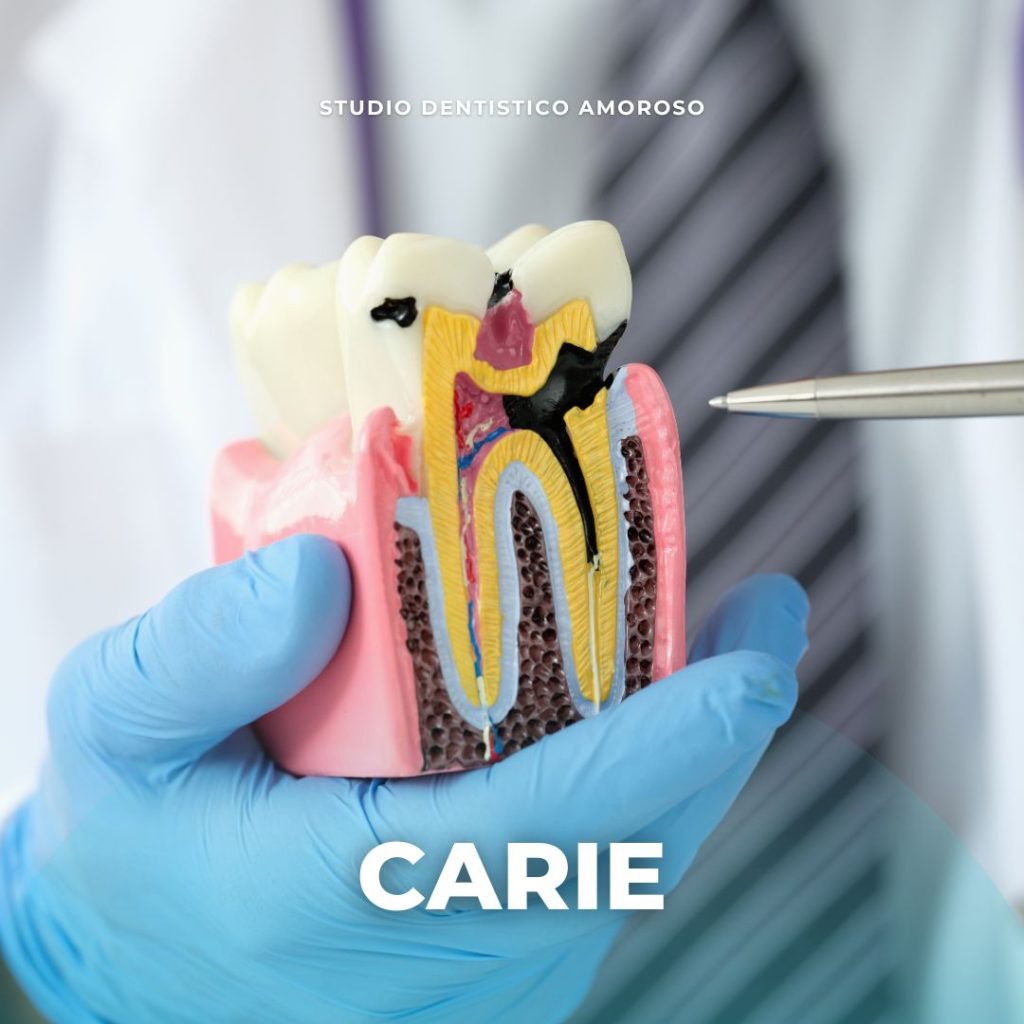 immagine che spiega il concetto di carie dentale