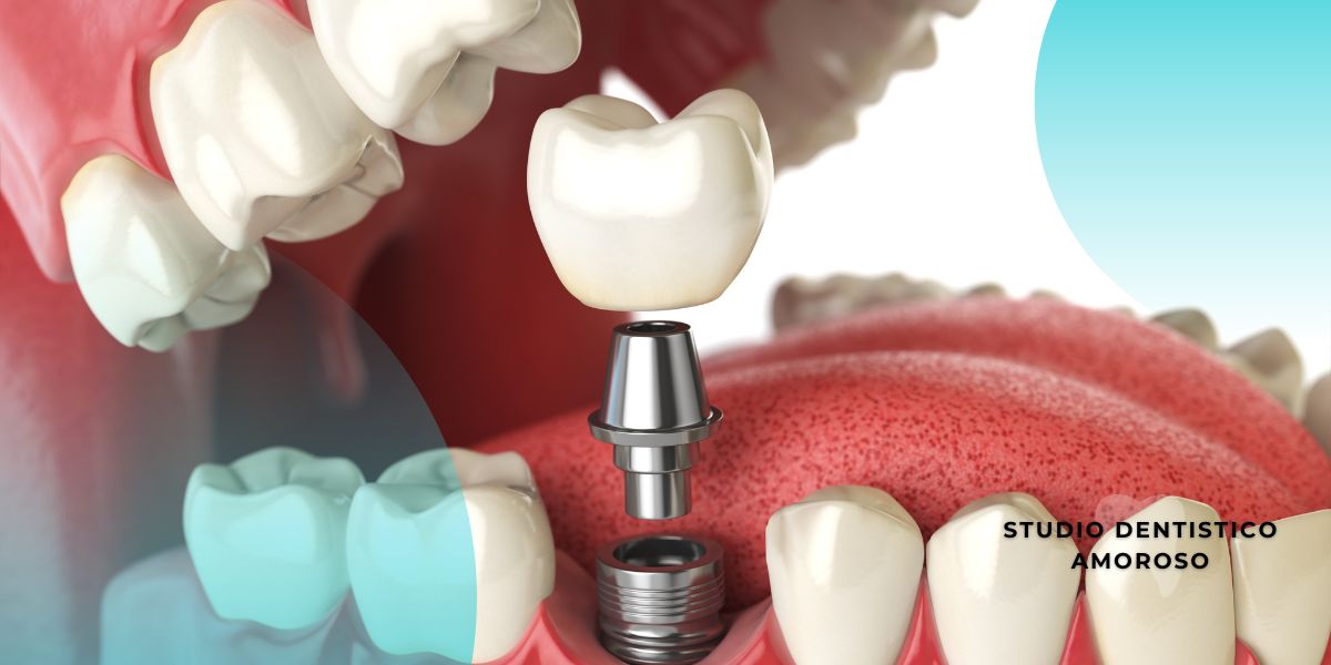 Immagine in 3D di un impianto dentale