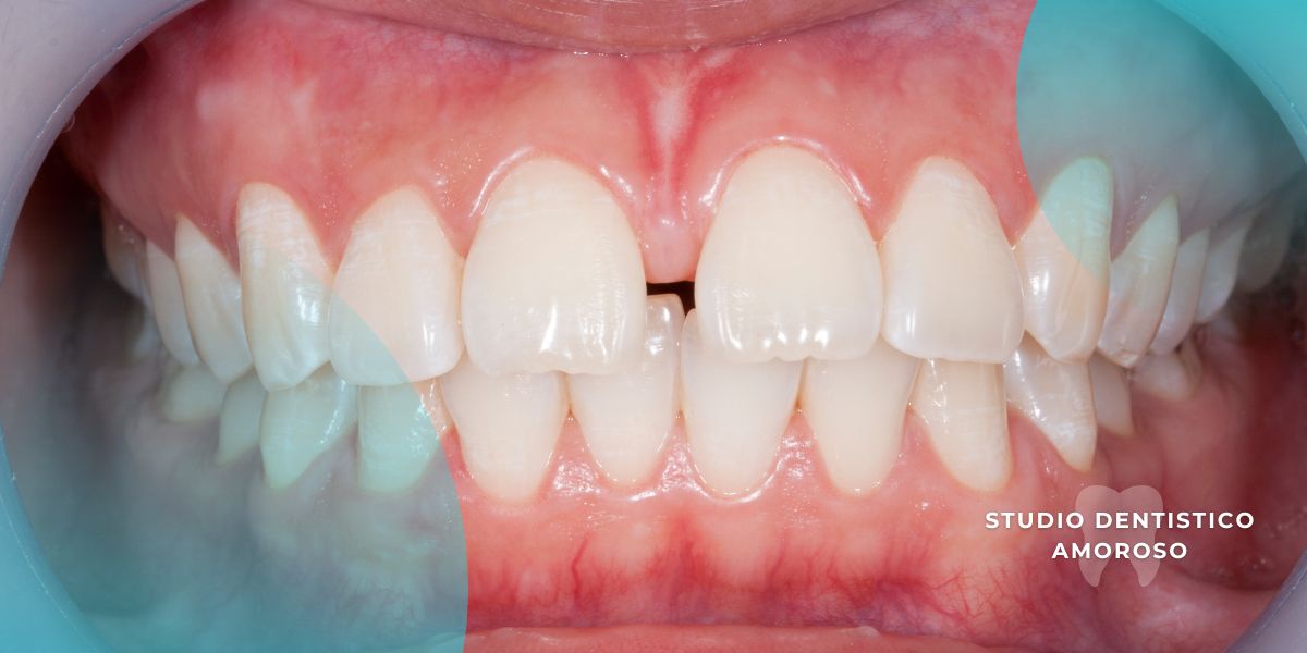 Caso clinico di un adulto con diastema dentale