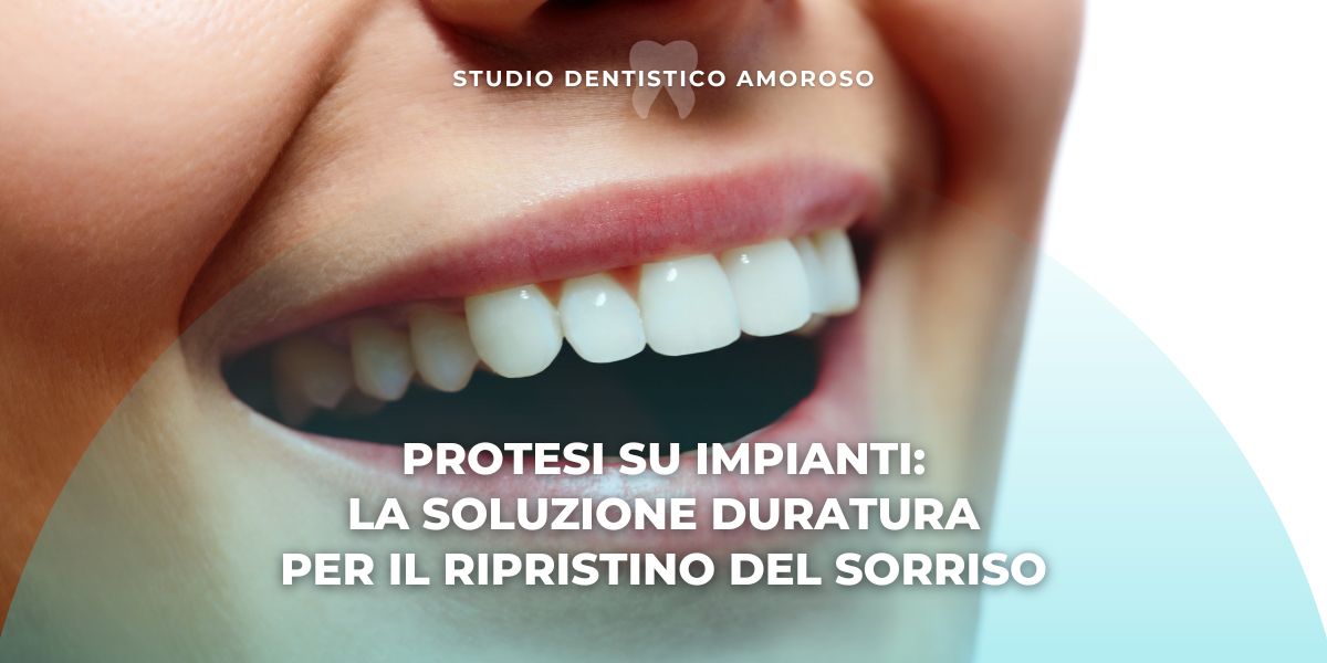 Protesi su impianti: la soluzione duratura per il ripristino del sorriso