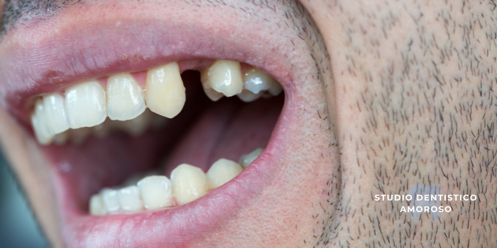 dente mancante per agenesia dentale