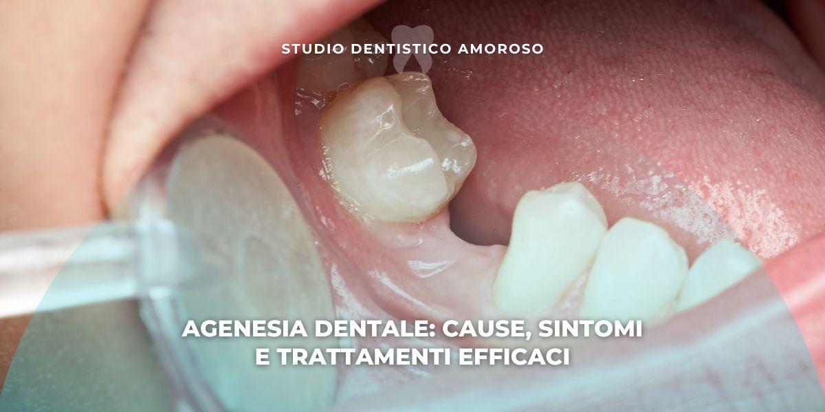 dente mancante per agenesia dentale