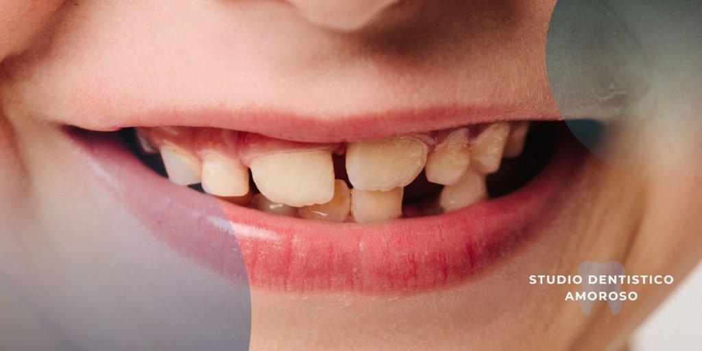 denti da latte in un bambino