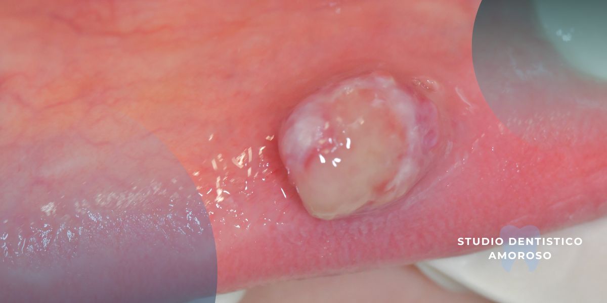 fibroma traumatico della mucosa orale