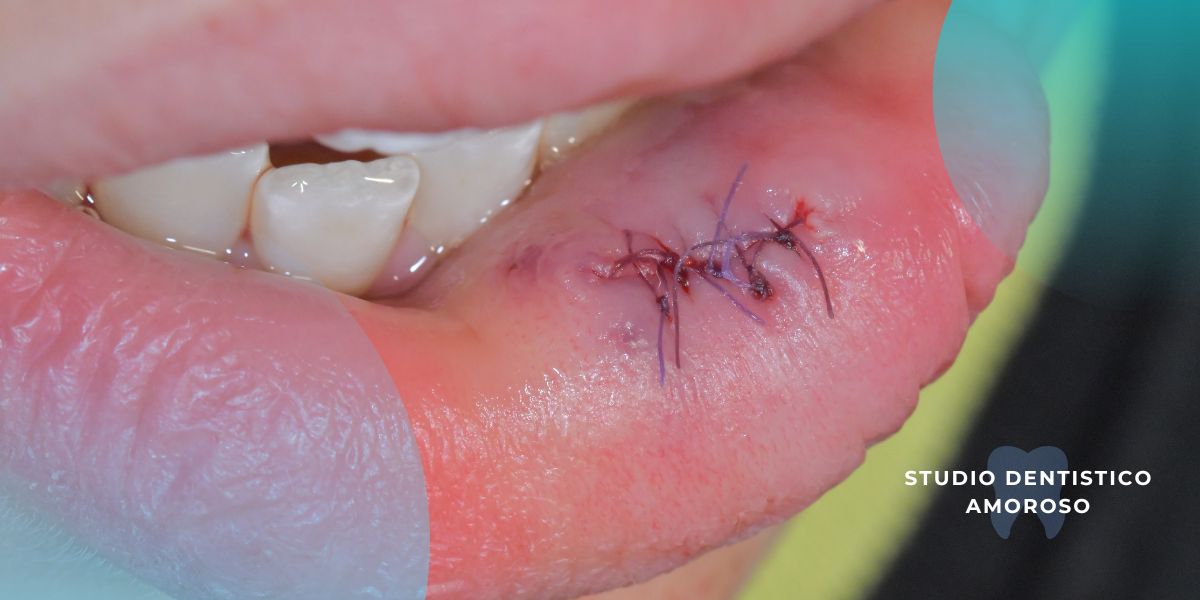 intervento di rimozione di fibroma traumatico del labbro