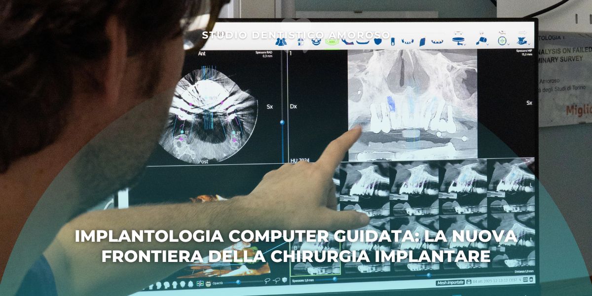 Dentista che analizza una TAC 3D sul computer per pianificare un intervento di implantologia computer guidata, la nuova frontiera della chirurgia implantare presso uno studio dentistico moderno.