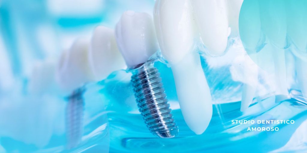 Implantologia All on 4: la guida completa per un sorriso fisso e funzionale Modello dentale con impianto All on 4 in titanio, Studio Dentistico Amoroso