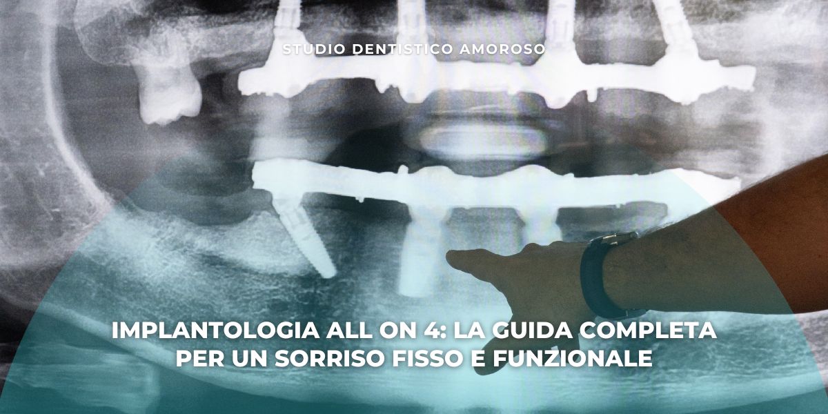 Radiografia dentale con impianti All on 4 indicati da un dentista, guida completa offerta da Studio Dentistico Amoroso