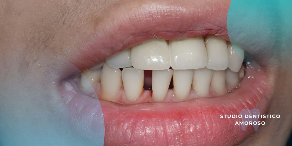 Denti piccoli e separati: cause, rischi estetici e soluzioni possibili Denti piccoli caso clinico