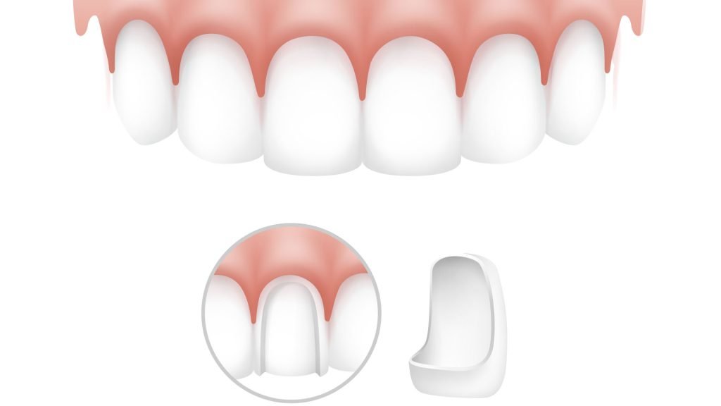 Le faccette dentali rovinano i denti? Facciamo un po' di chiarezza