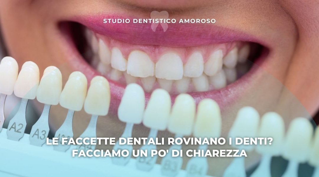 Le faccette dentali rovinano i denti? Facciamo un po’ di chiarezza
