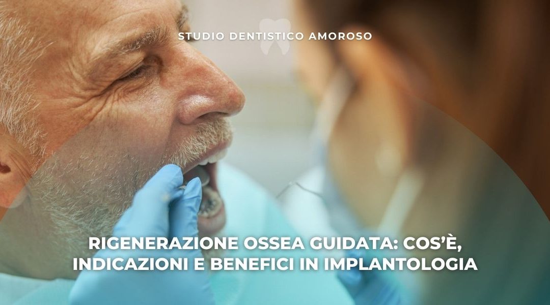 Rigenerazione ossea guidata: cos’è, indicazioni e benefici in implantologia