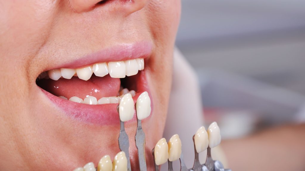 Le faccette dentali rovinano i denti? Facciamo un po' di chiarezza